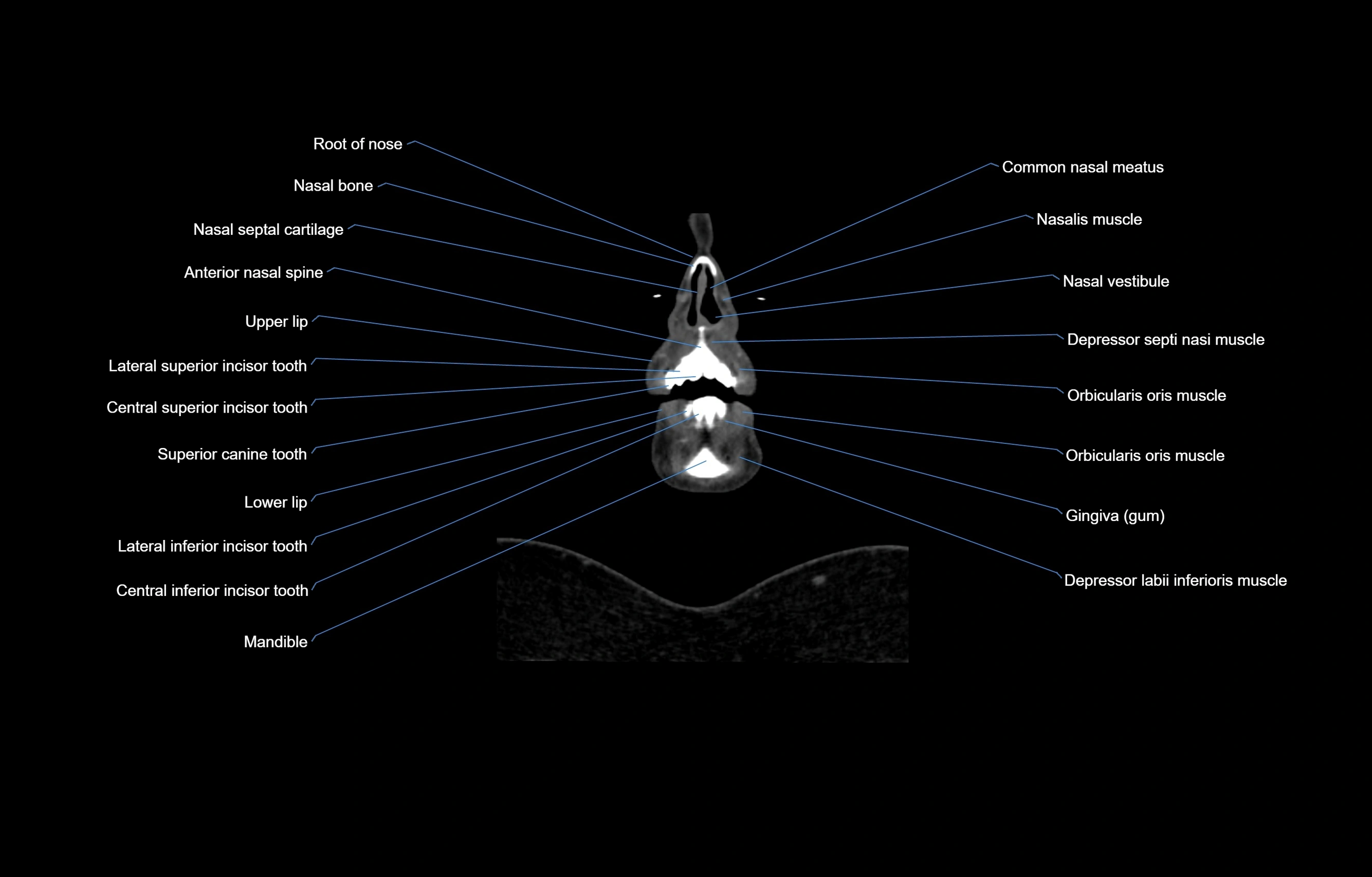CT Neck coronal  cross sectional anatomy labelled 3D  radiology  image-00007.webp